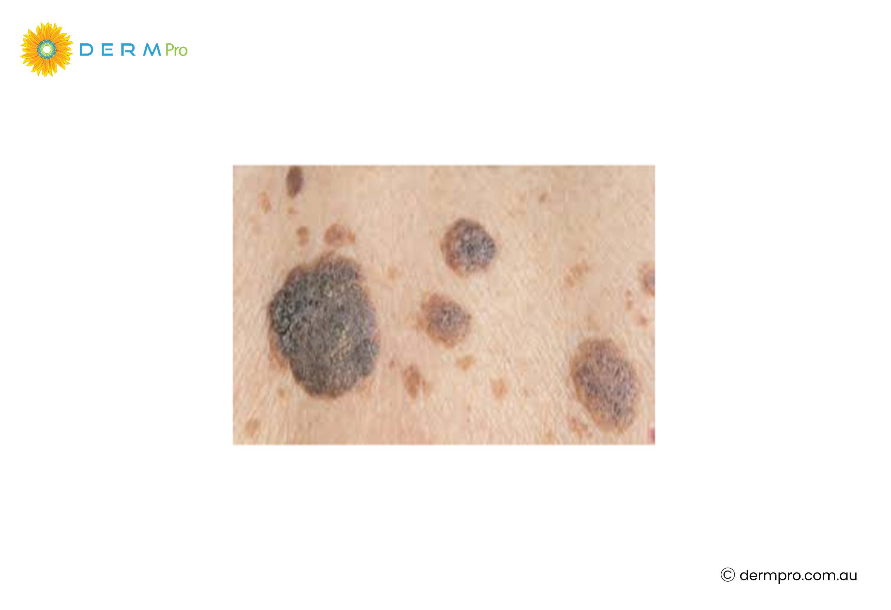 Seborrheic Keratoses images
